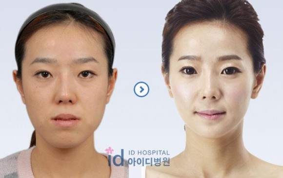 ศัลยกรรมเกาหลี